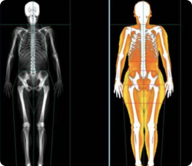 DEXA SCAN IN BOSTON, MASSACHUSETTS